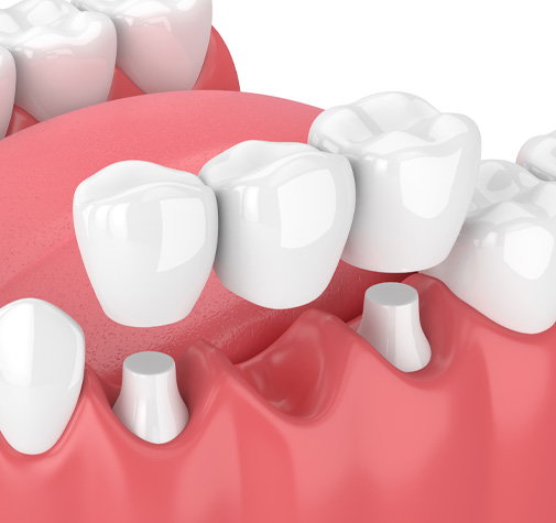 illustration of a dental bridge