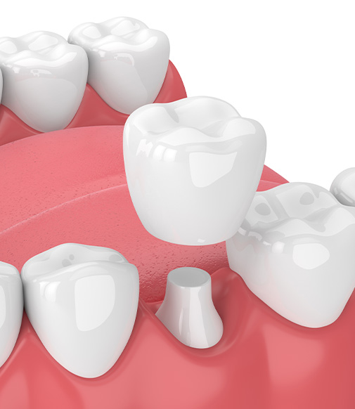 illustration of a dental crown