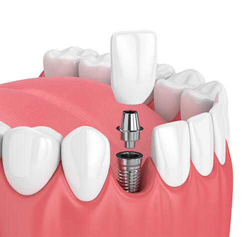 illustration of a dental implant