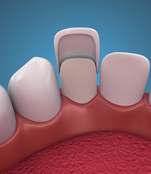 illustration of a porcelain veneer