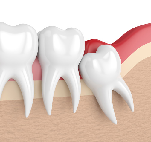 illustration of an impacted wisdom tooth