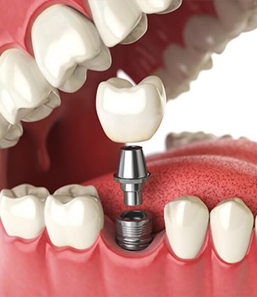 illustration of an implant