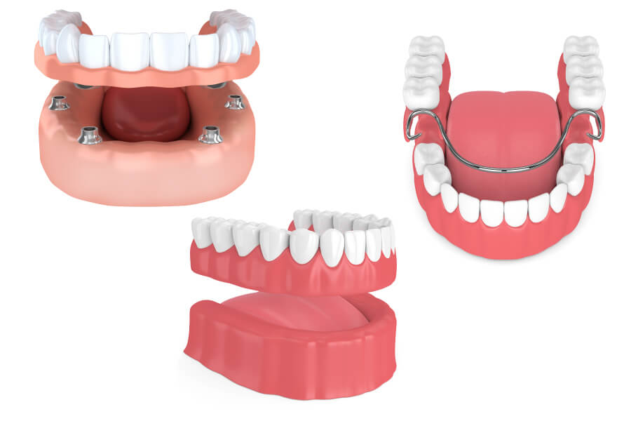 Implant-supported dentures, removable full dentures, and partial dentures to replace missing teeth