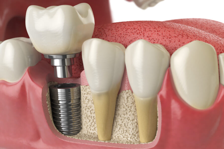 Closeup of a dental implant in a patient's jawbone to replace a missing tooth