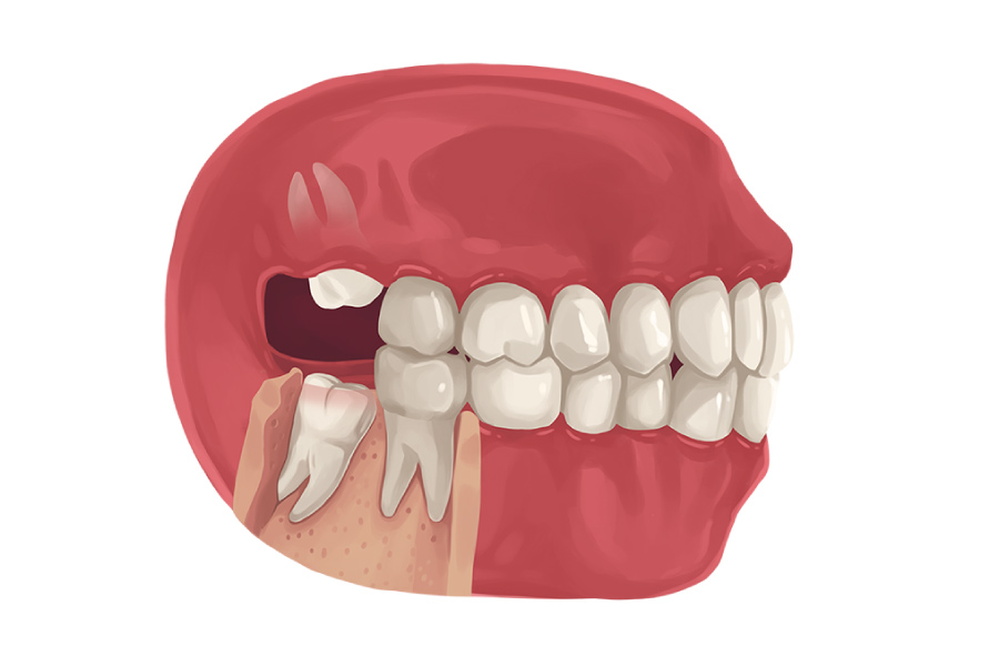 A model showing upper and lower wisdom teeth growing in at odd angles.