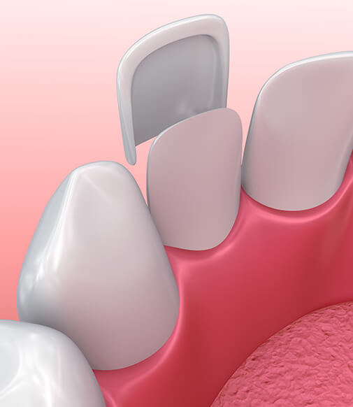 illustration of how veneers are applied